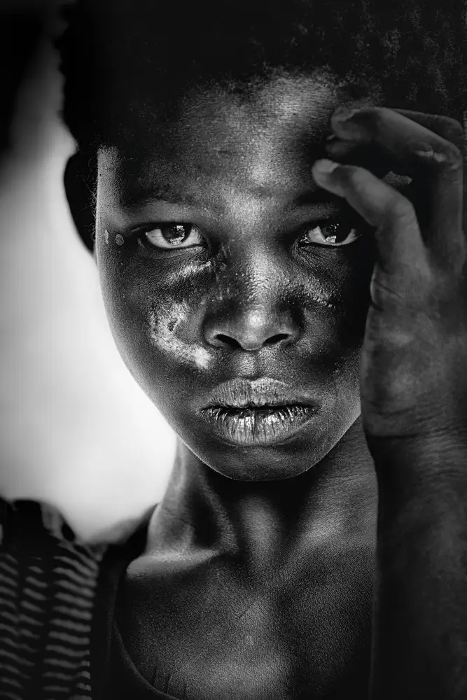 Pandolfini, Sergio: Niña con cicatrices - Benin (África)